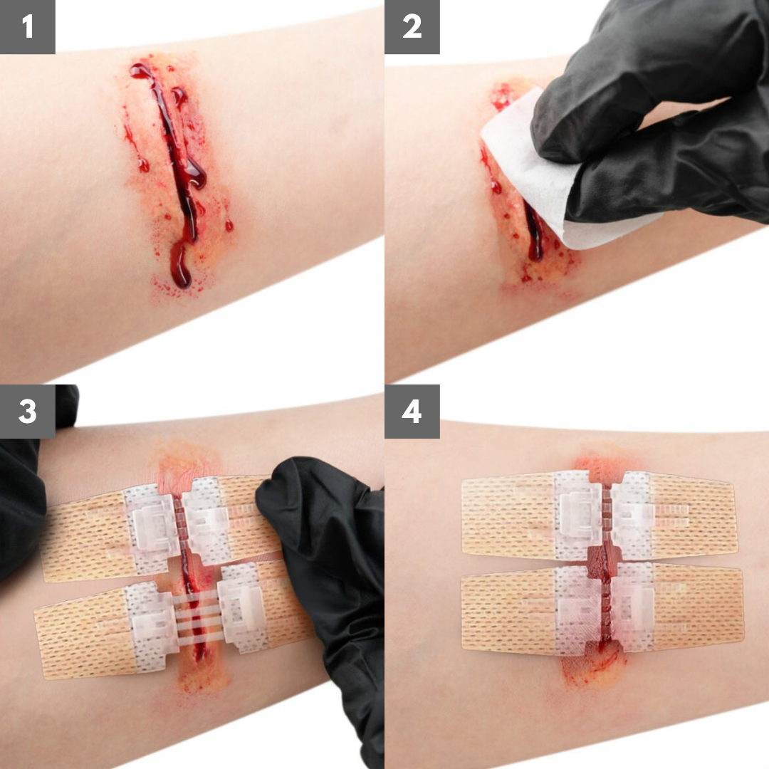 Venator™ Advanced ZipClose Stitches